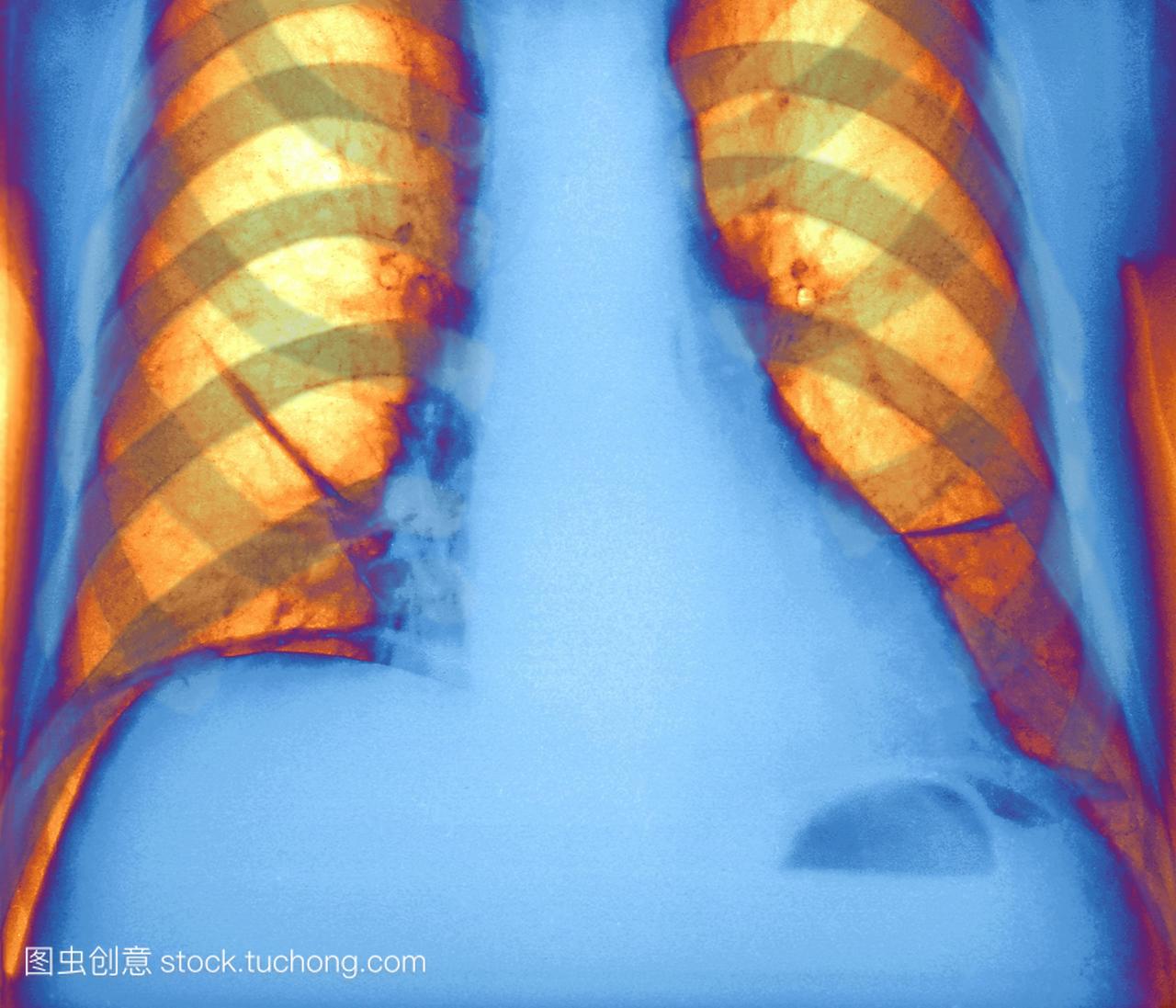 倒塌的肺彩色的x射线。左肺右,肺不张因气腹气