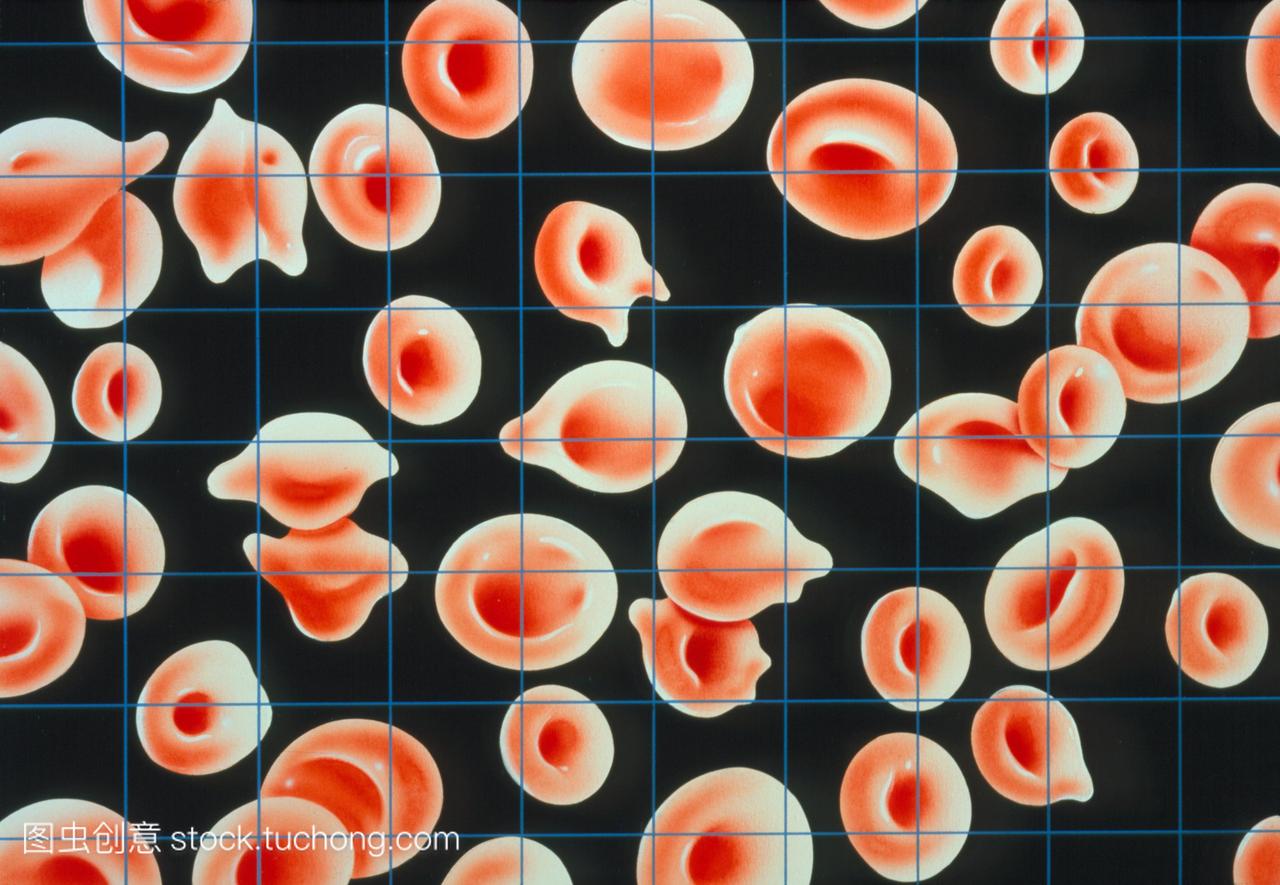 红血球在妊娠期间缺铁性贫血的例子。这种最常