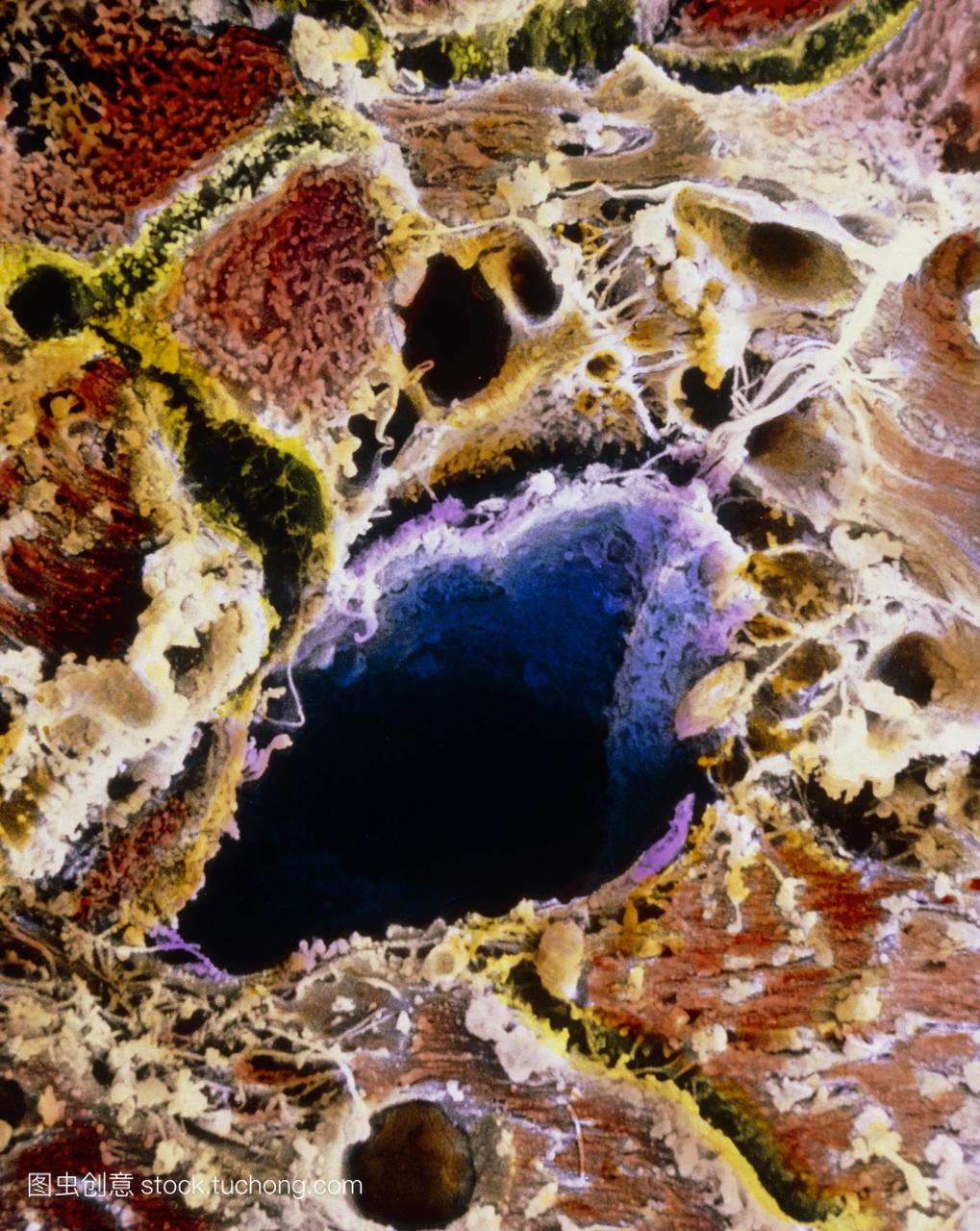 细胞结构,受到肝硬化的影响。肝细胞暗棕色围