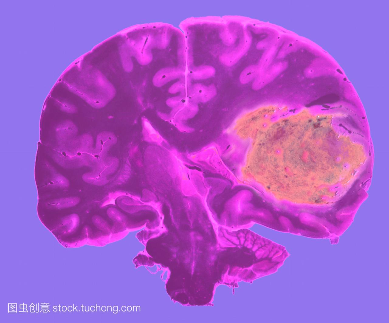 脑部肿瘤。通过大脑显示一个大肿瘤粉红色,右