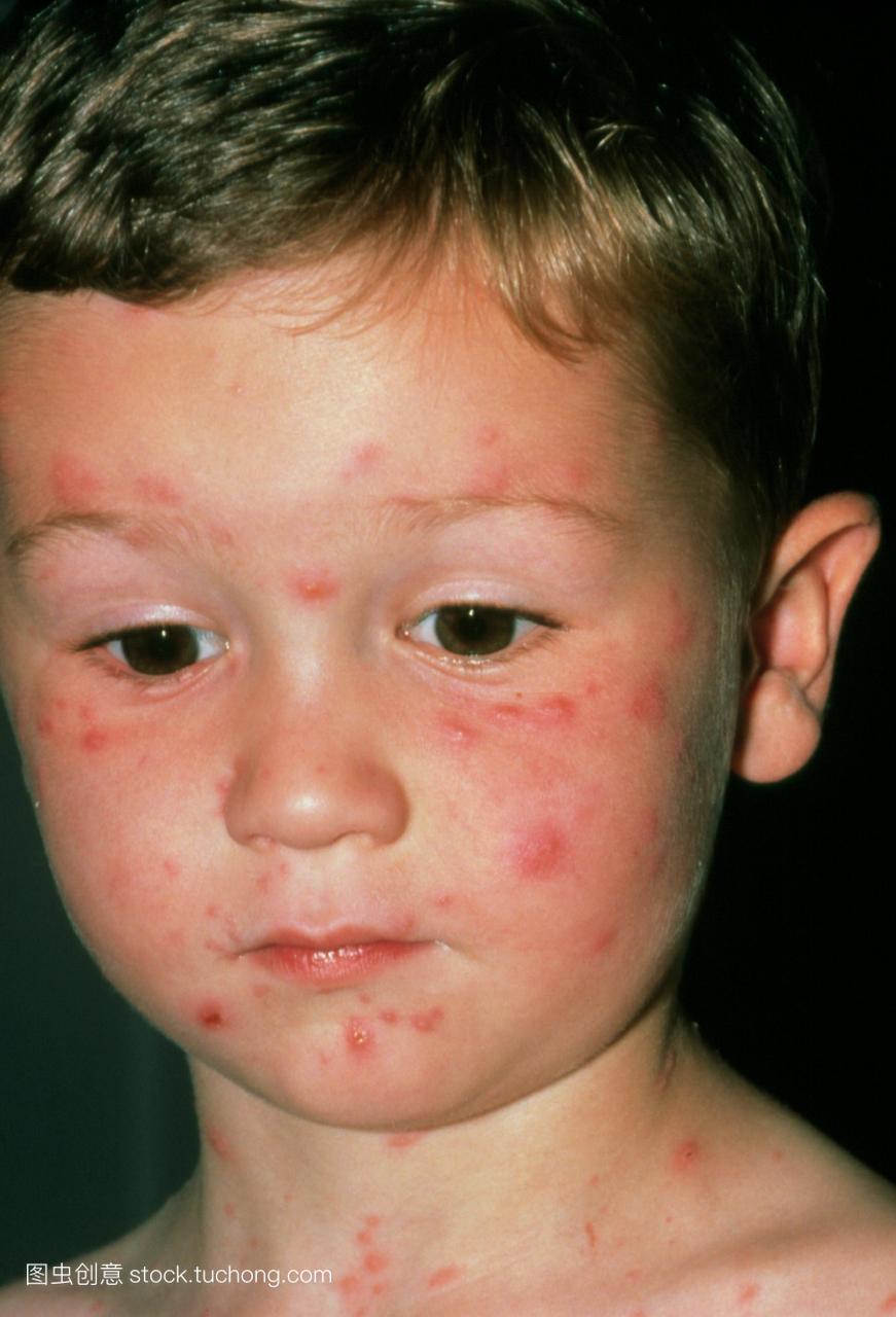 孩子受到水痘也称为水痘。它是一种温和的传染