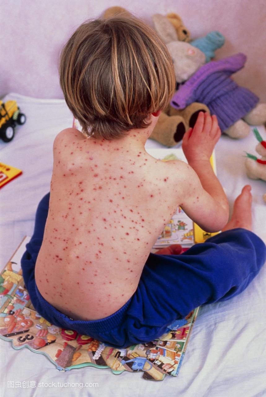 是一种儿童传染病,其特征是皮疹和轻微发热。
