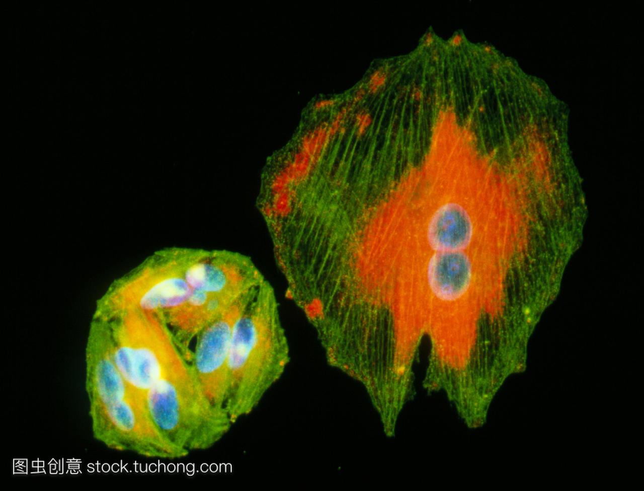 Immunofluorescent光显微照片黑色素瘤癌细胞