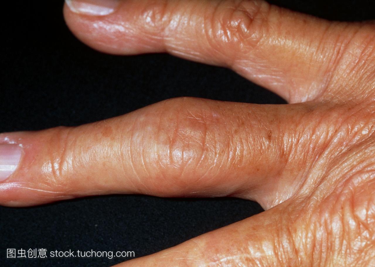 骨关节炎。一名69岁妇女的手,她的手指受到骨