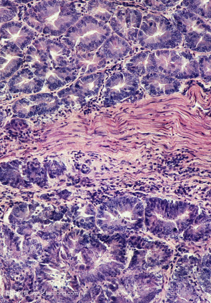 称为胃腺癌。上方和下方中心紫色可见胃腺体大