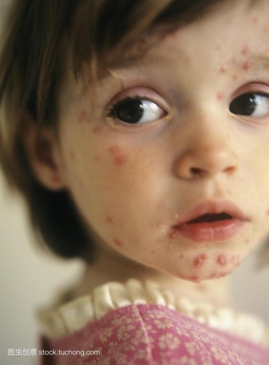 轻女孩的脸。这是一种由水痘-带状疱疹病毒引