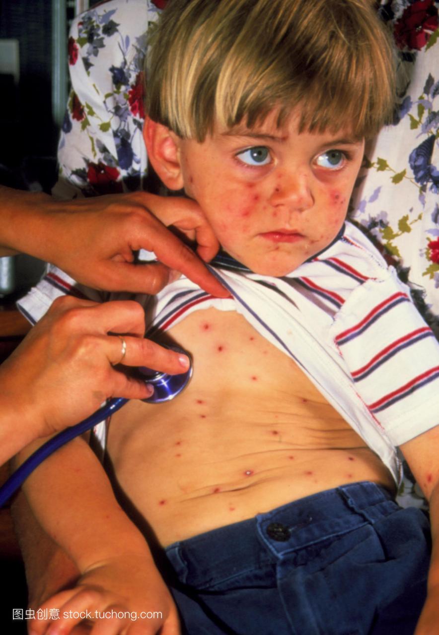 是一种儿童传染病,其特征是皮疹和轻微发热。