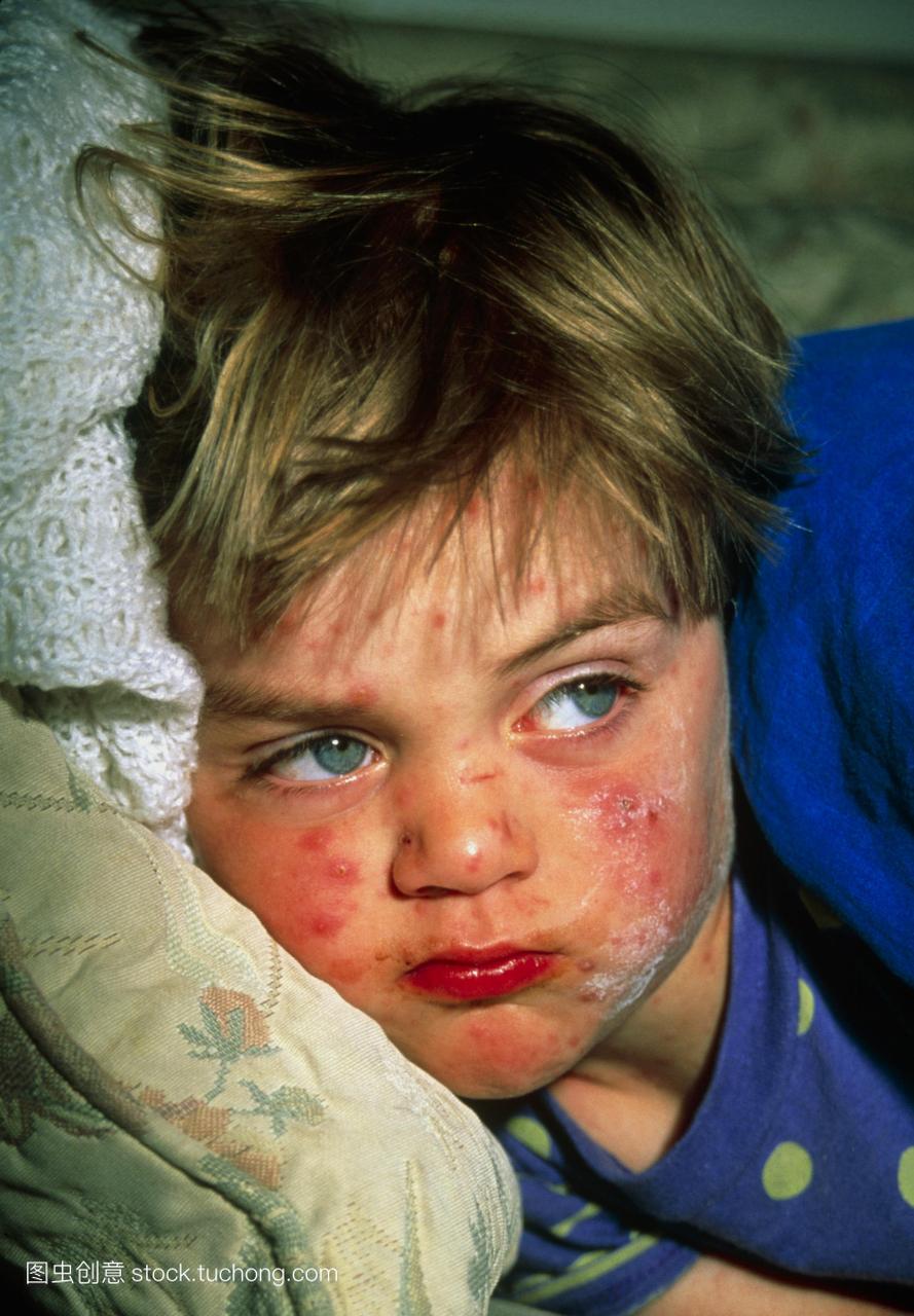 男孩患有水痘感染与炉甘石液应用到他的脸上。