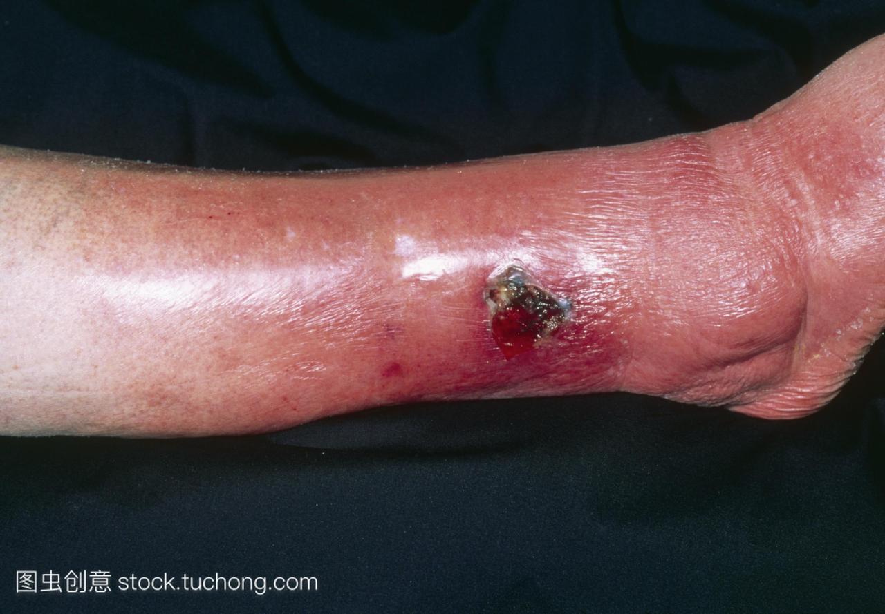 蜂窝组织炎。蜂窝织炎由于腿部的静脉曲张溃疡