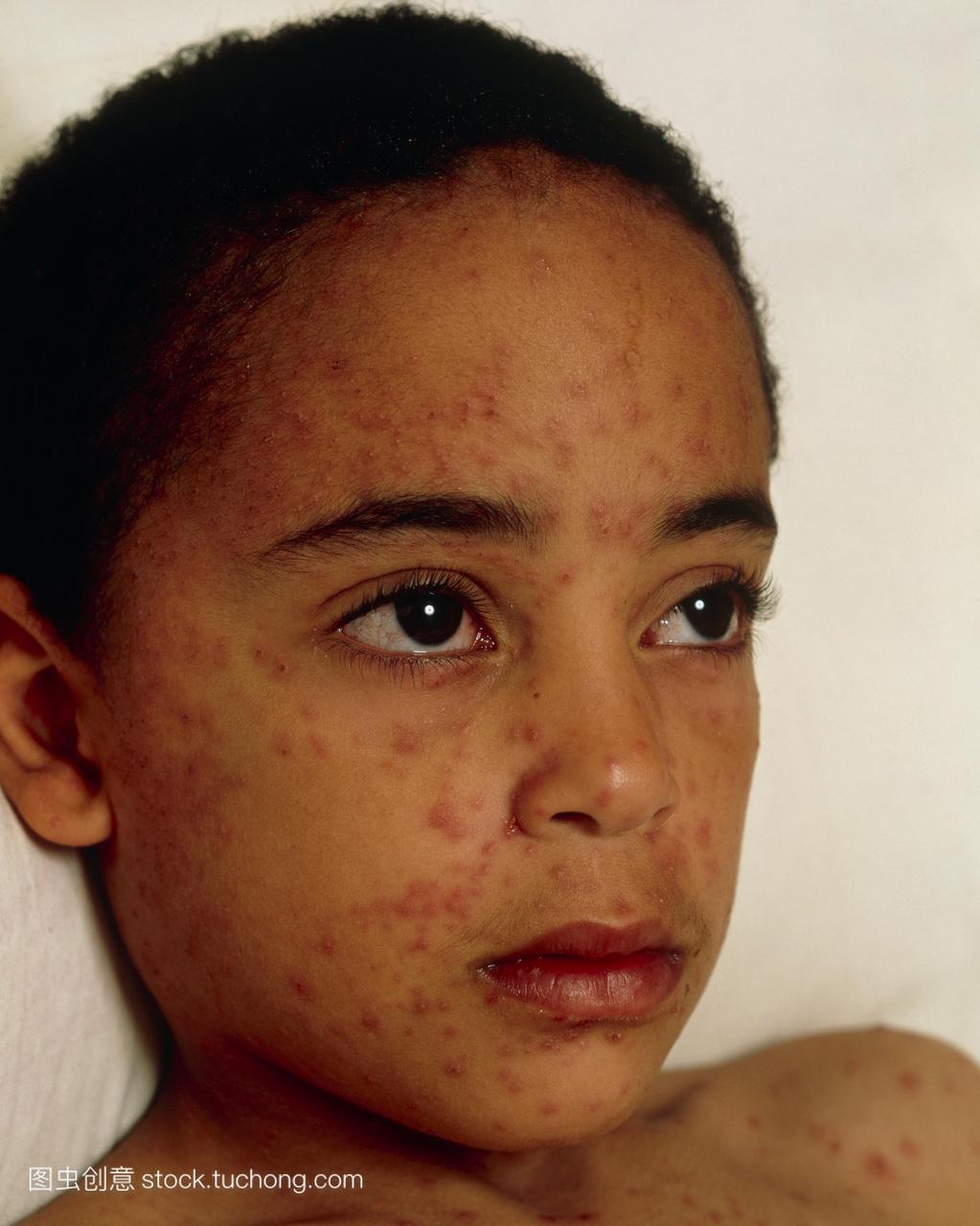 水痘。小男孩的脸上有水痘。水痘水痘是儿童常