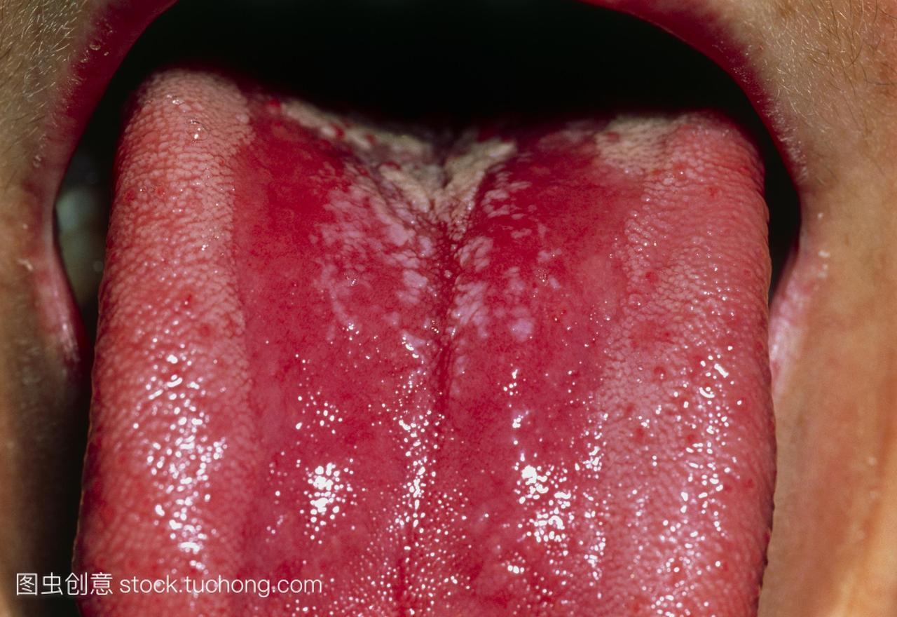 口腔鹅口疮由于类固醇特写镜头的舌头一个21