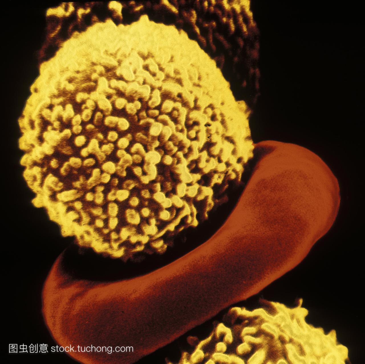 白血病。伪彩色扫描电子microgr--aph白细胞黄