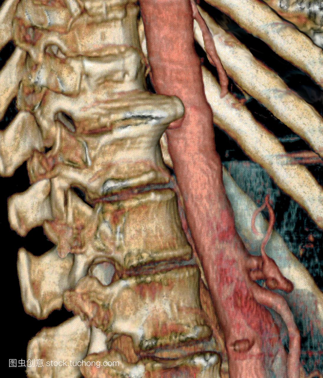 关节疾病。彩色3-d计算机断层扫描ct在脊柱侧