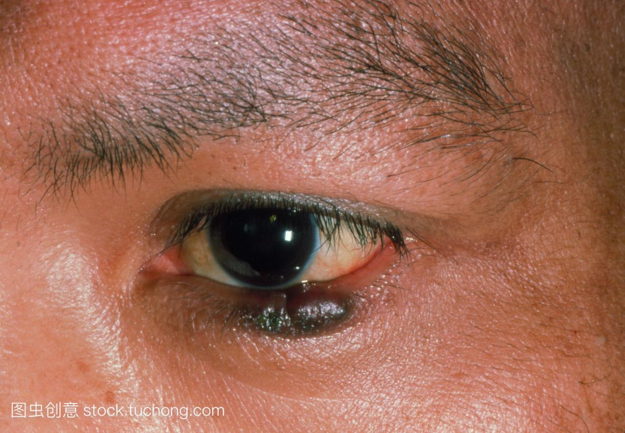 眼睑带状疱疹及引起的病毒性角膜炎的经验治疗_带状疱疹_介绍_治疗方式 - 好大夫在线