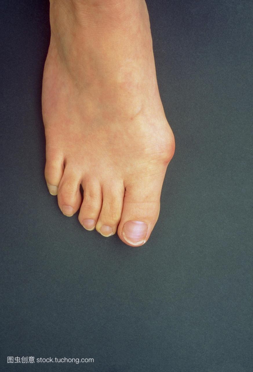 一个女人右脚上的拇囊炎。拇囊炎是趾趾和第一