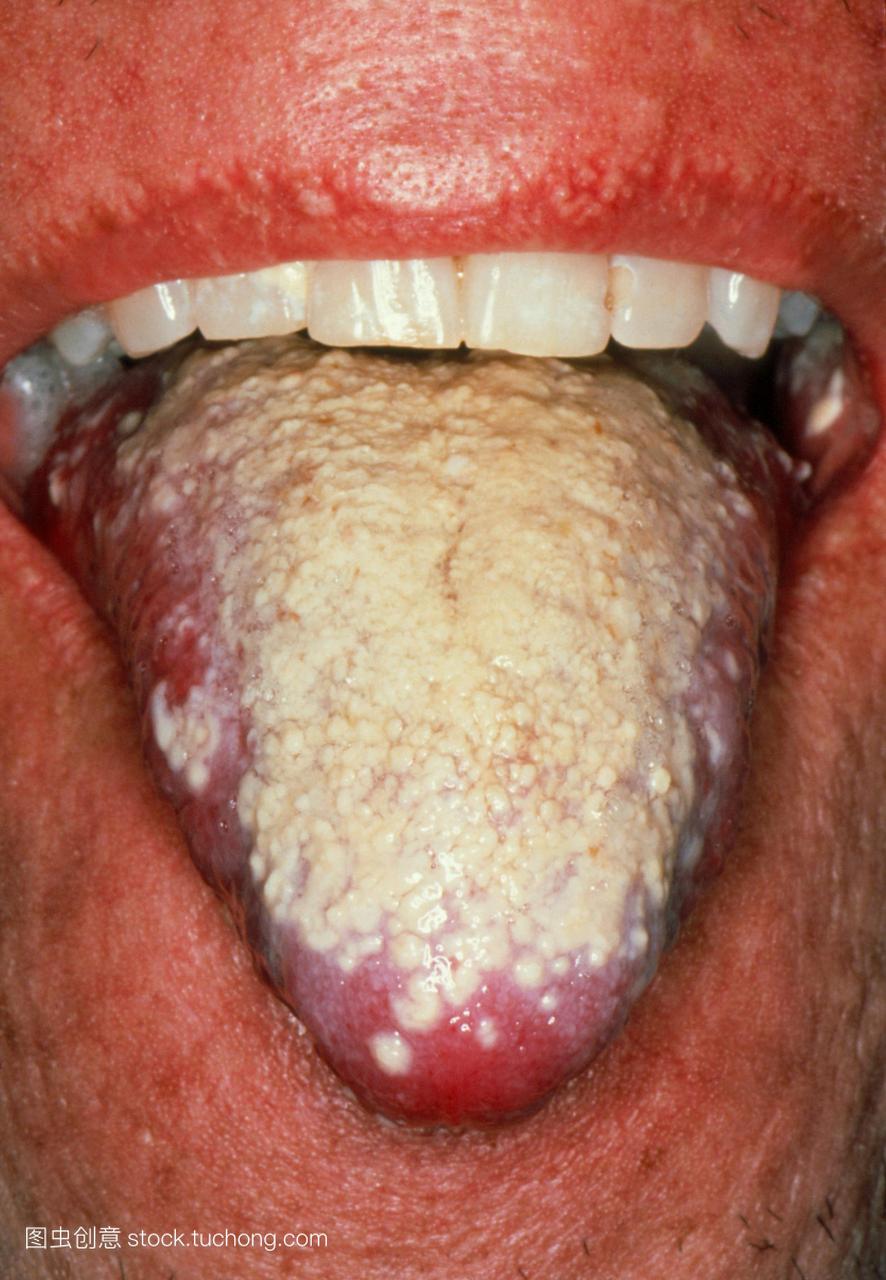 严重的口腔念珠菌病,显示一层厚厚的,乳白色的