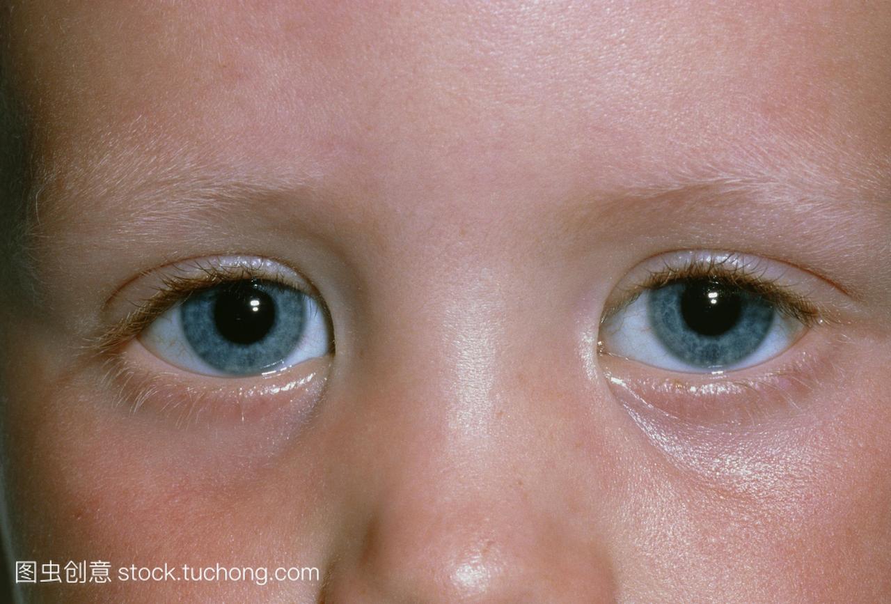 内眦赘皮的折叠在正常的孩子的眼睛。垂直折叠