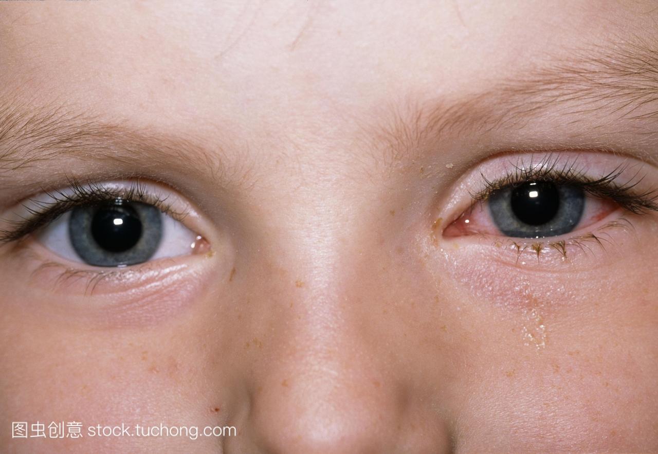 布。6岁男孩左眼的病毒性结膜炎。眼睛充血,流