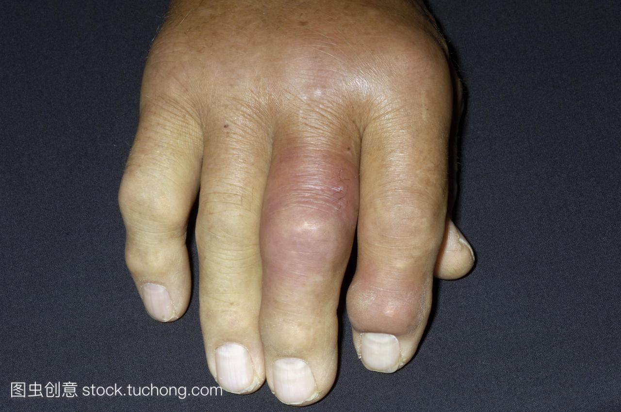 痛风。由痛风引起的81岁老人肿胀的手指。这