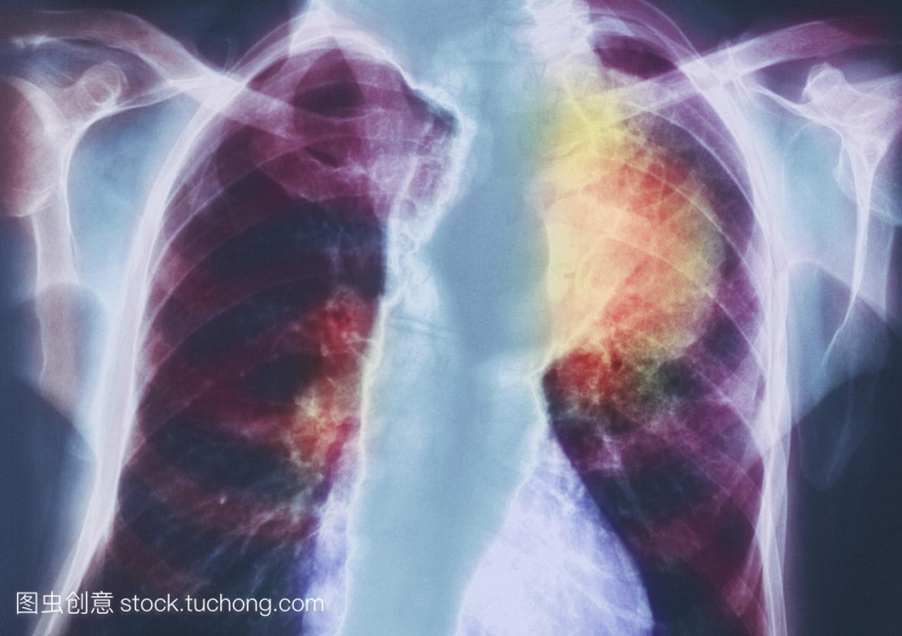 肺癌。一名70岁妇女的彩色胸部x光片显示肺癌