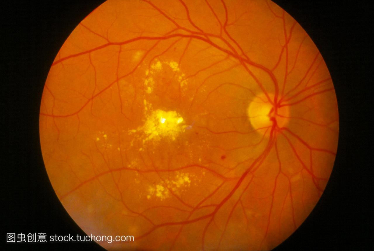 糖尿病黄斑病变。视网膜黄斑病变患者视网膜病
