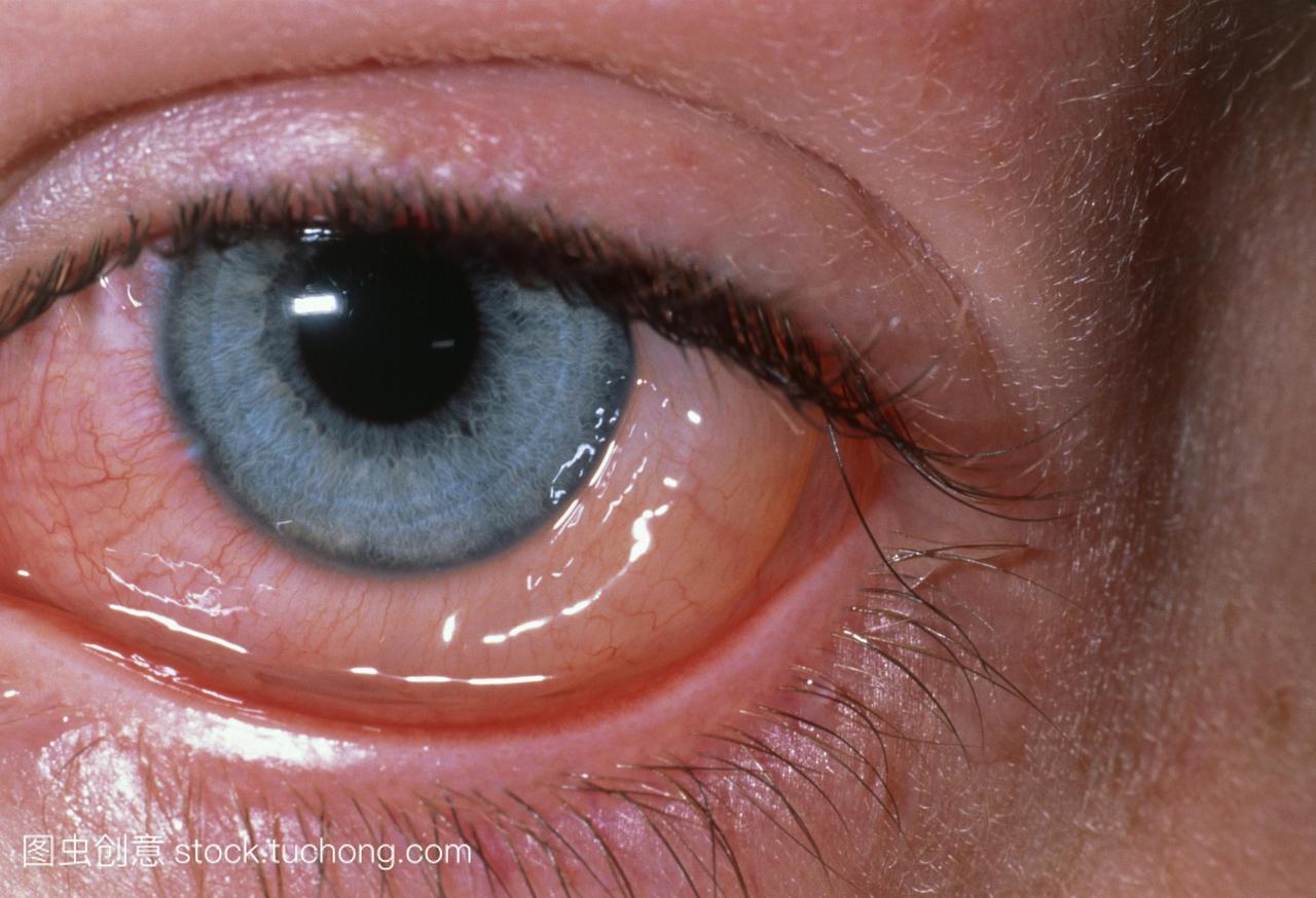 过敏性结膜炎。患者眼睛的特写显示过敏性结膜
