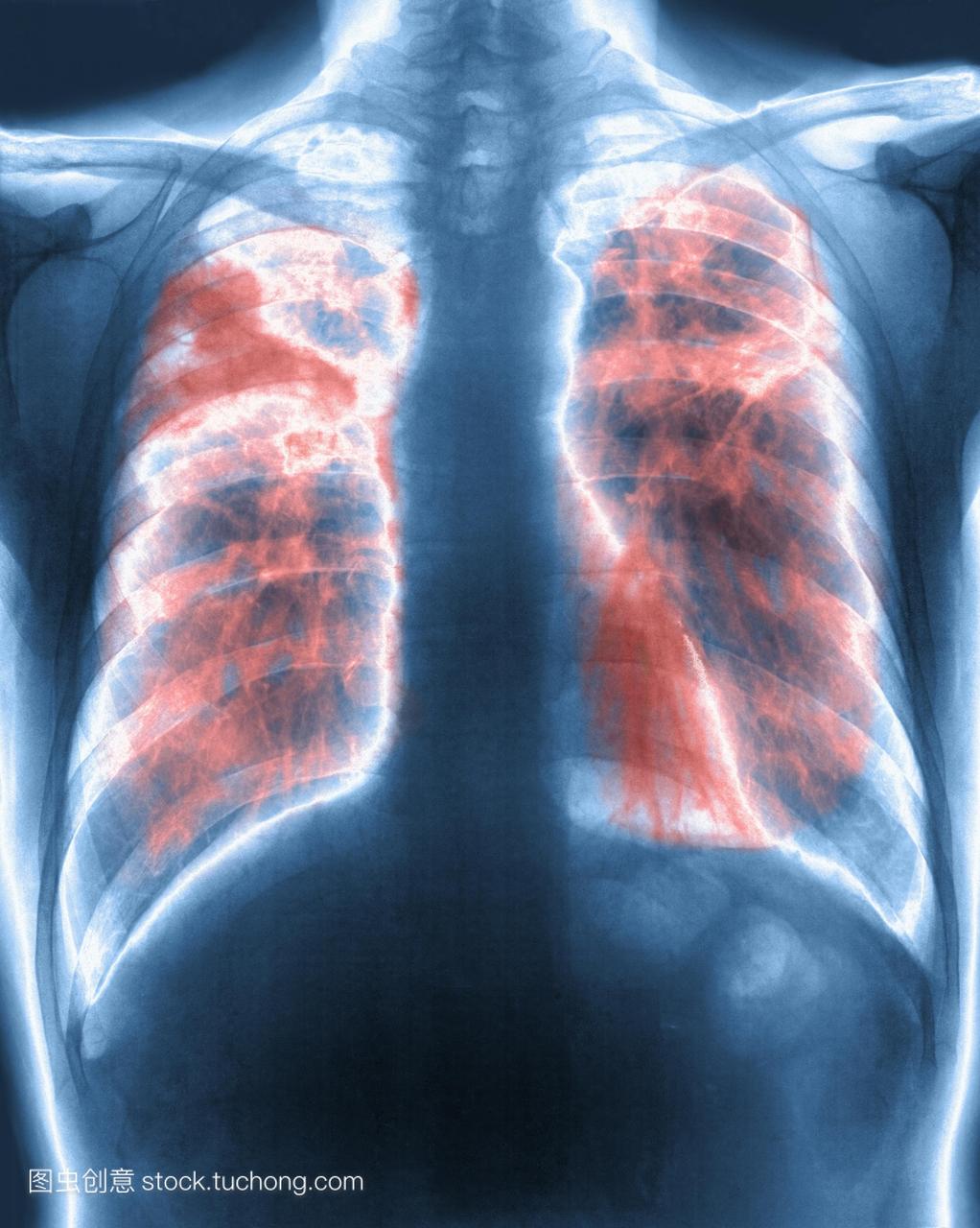 肺纤维化。彩色的胸部x光患者肺纤维化肺或间
