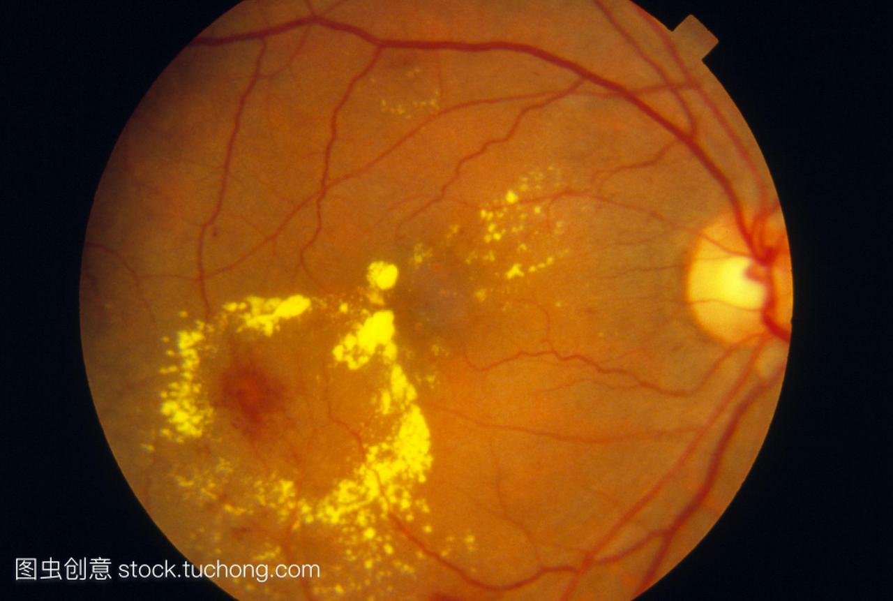 糖尿病黄斑病变。一名糖尿病患者视网膜的检眼