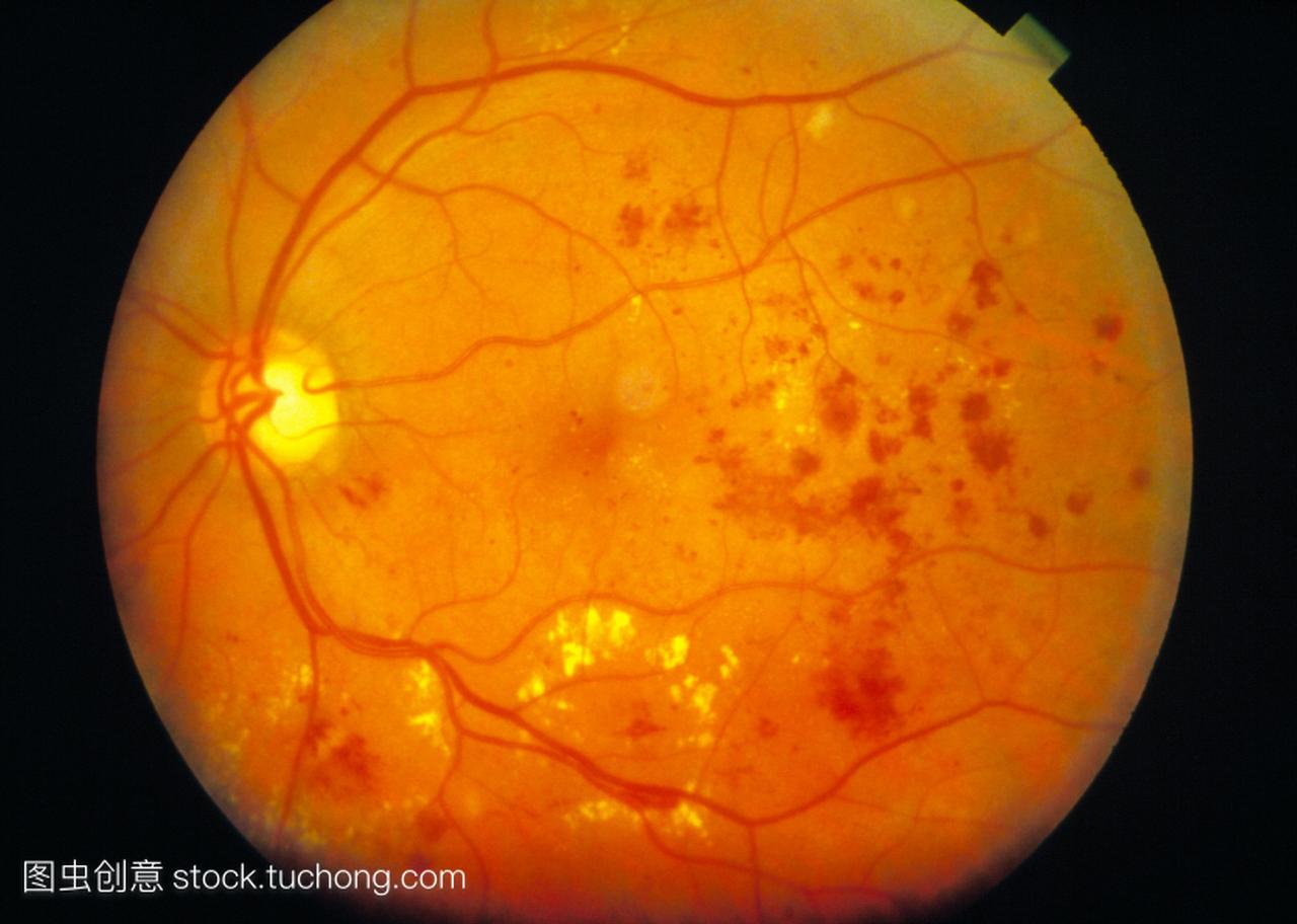 尿病黄斑病变。检眼镜的糖尿病患者的视网膜显