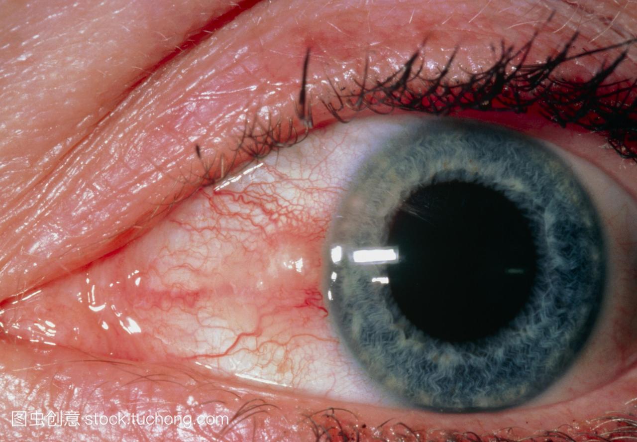 发炎结膜黄斑。用发炎的pinguecula对病人的眼