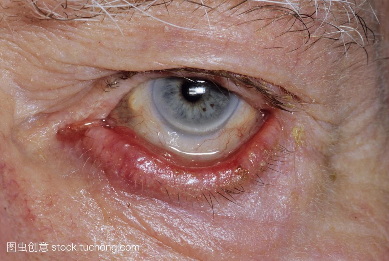 在一个87岁的男人中,下眼睑的外翻。这是眼睑