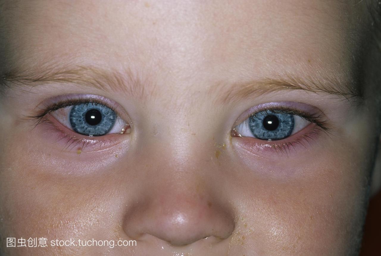模型发布。1岁男孩的两眼病毒性结膜炎。眼睛