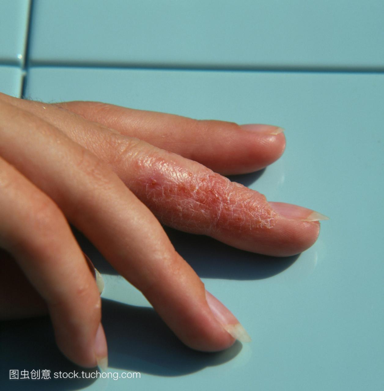 的炎症,主要影响表皮。它会引起瘙痒和红疹,通