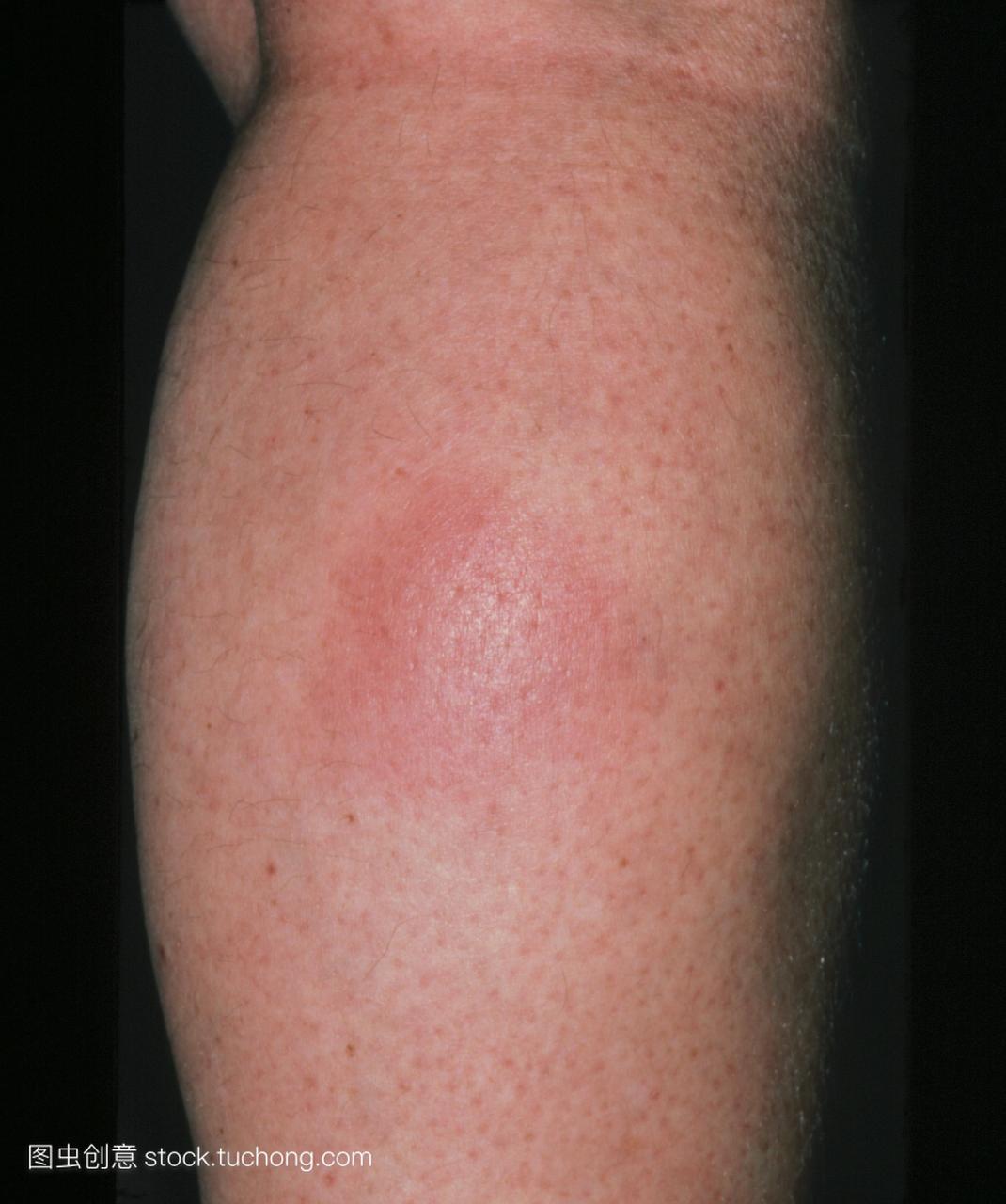 小腿结节性红斑。这种情况的特点是一个红色的