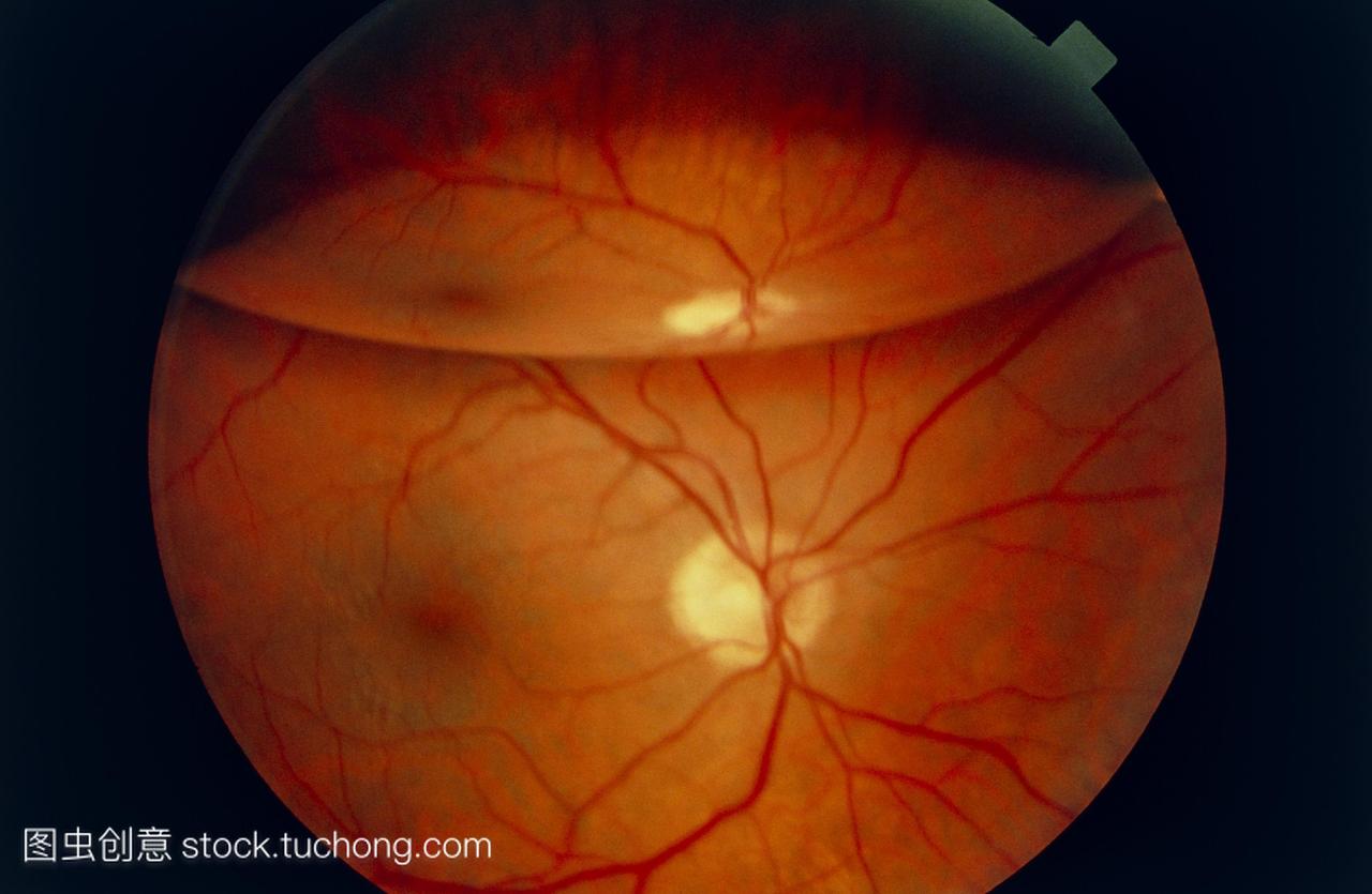 分离视网膜检眼镜的病人的眼睛视网膜分离视网