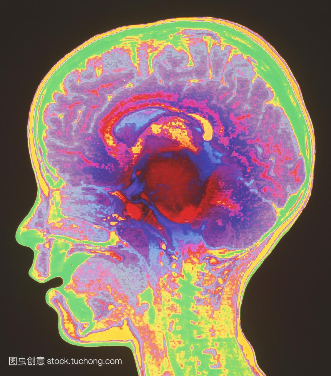 mri扫描矢状面垂直部分,通过脑胶质瘤脑瘤深红