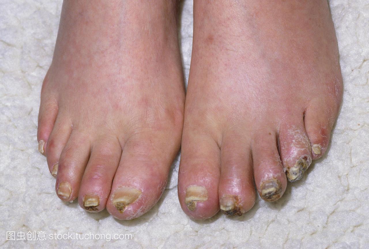 水肿肿胀和坏疽影响一个人的脚趾。坏疽是由于