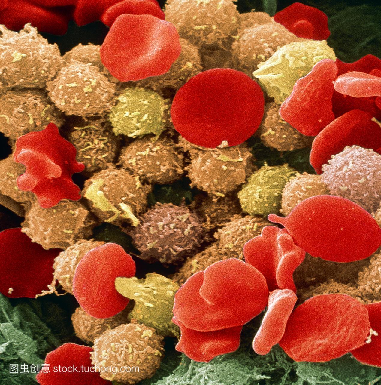 白血病血细胞。彩色扫描电子显微镜sem的血液