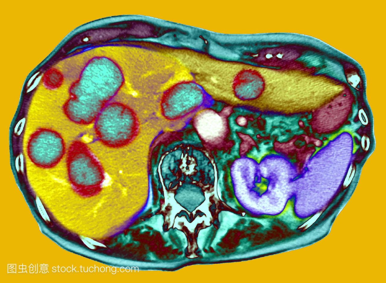 色计算机断层扫描ct扫描的大量肿瘤浅蓝色在肝