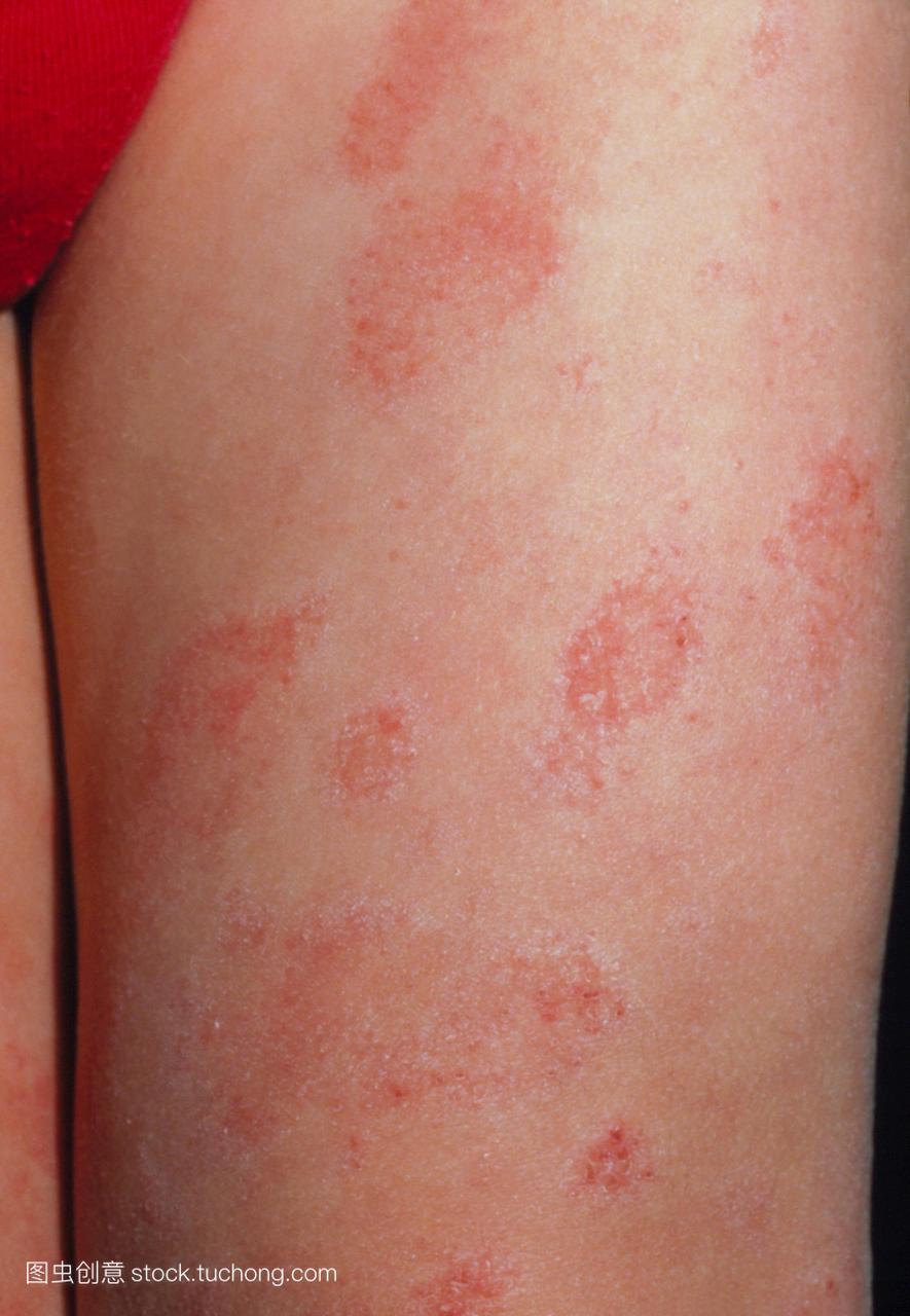 湿疹。的腿一个孩子患有湿疹。零零碎碎红色皮