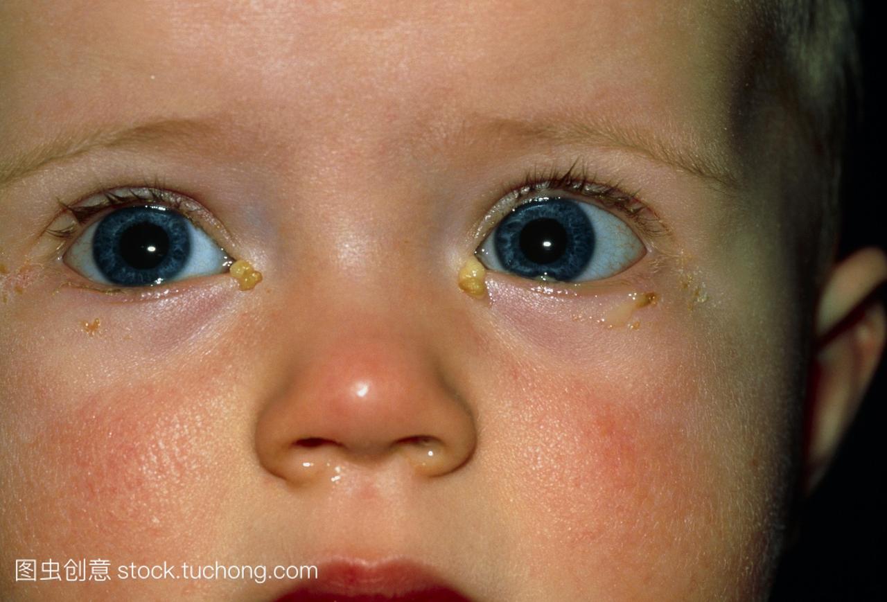 近距离观察1岁的婴儿急性结膜炎。在孩子的眼