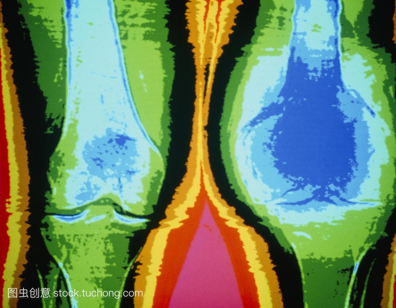 骨癌。彩色计算机断层扫描ct扫描显示左膝图像