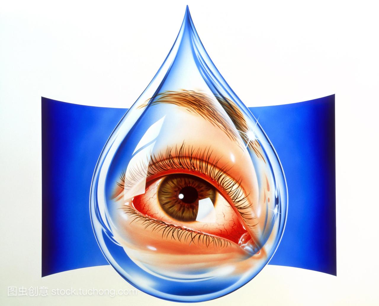 影响的眼睛放电。最常见的原因是感染和过敏。