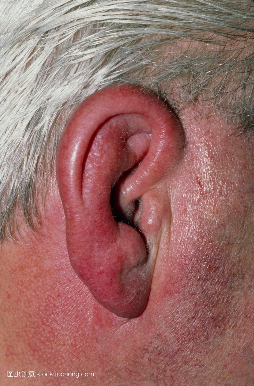 丹毒。近旁耳管炎外耳道炎感染后,人的耳朵的