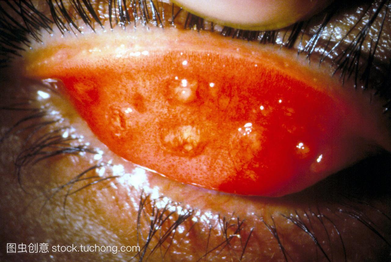 沙眼的眼睑炎症,是一种慢性,传染性的眼病,是由