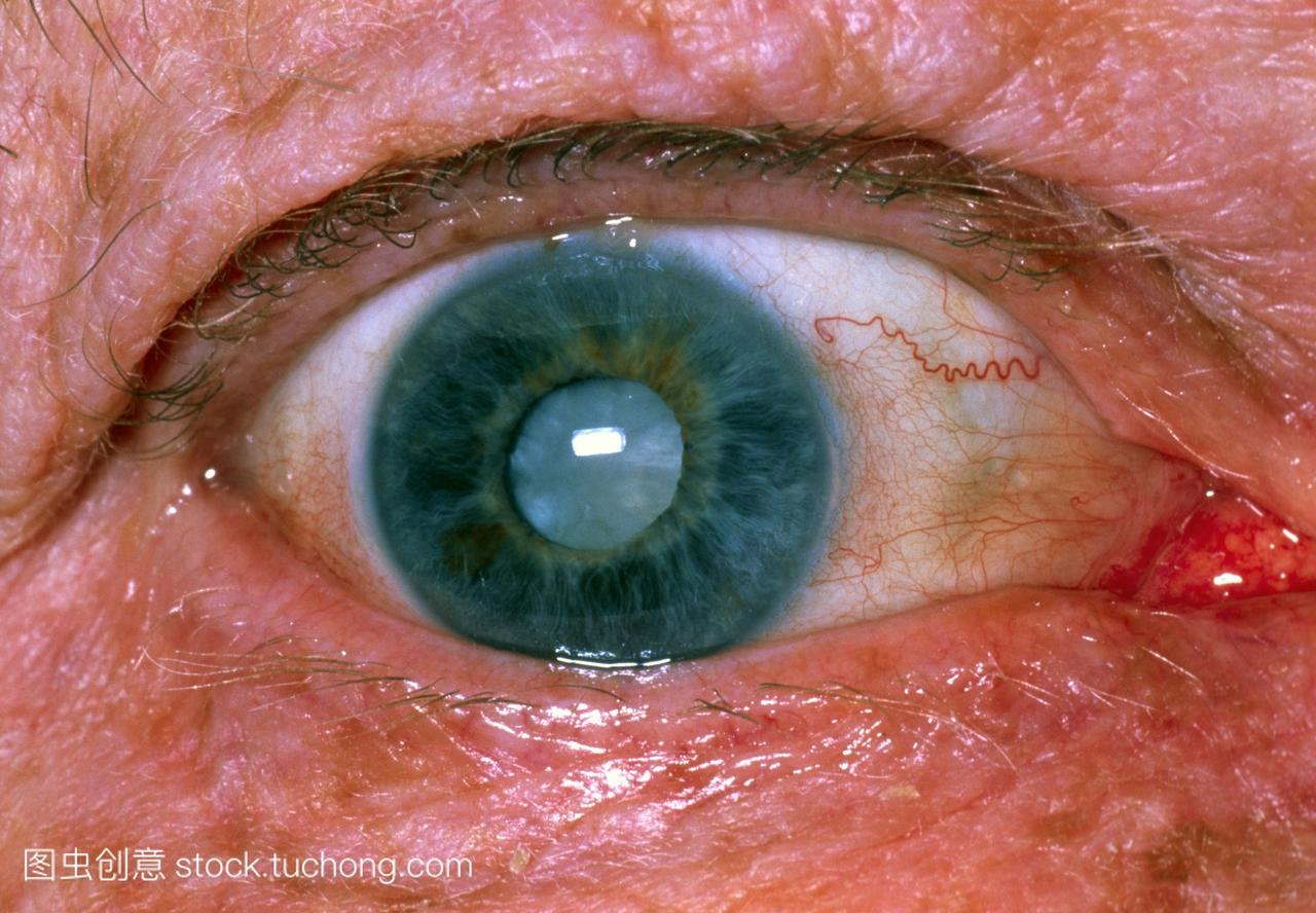 白内障的眼睛的特写镜头一位69岁的女人展示