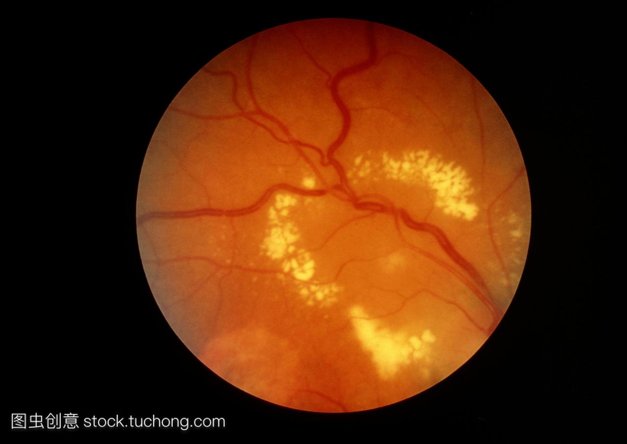 变在严重的糖尿病视网膜病变的情况下,眼睛视