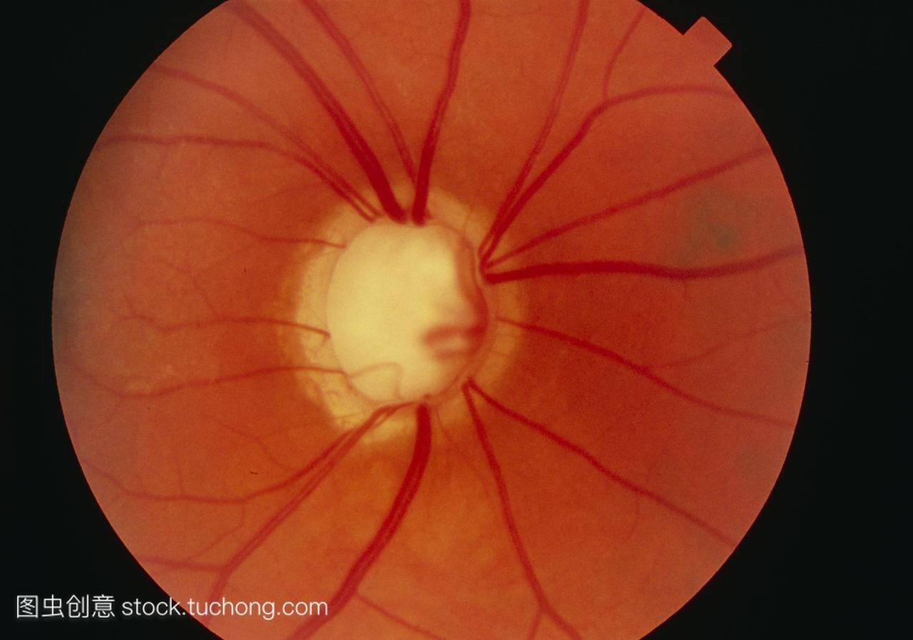网膜在青光眼的情况下,显示视盘的拔罐,图像中