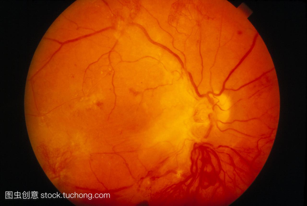 糖尿病视网膜病变眼底影像显示视网膜病变的视