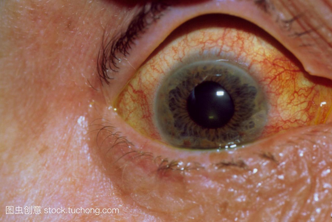 特写的疼痛红肿的眼睛在急性青光眼不规则扩大